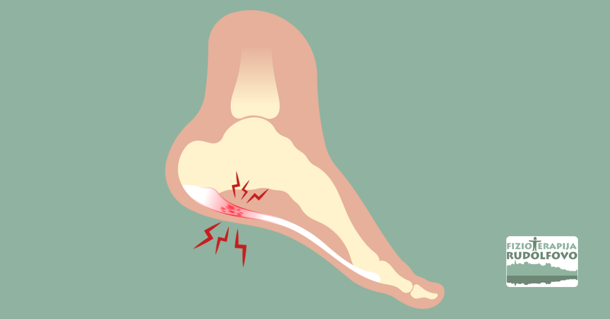 Diagram lokalizacije bolečine pri plantarnem fasciitisu - rdeče označena območja na peti in stopalu