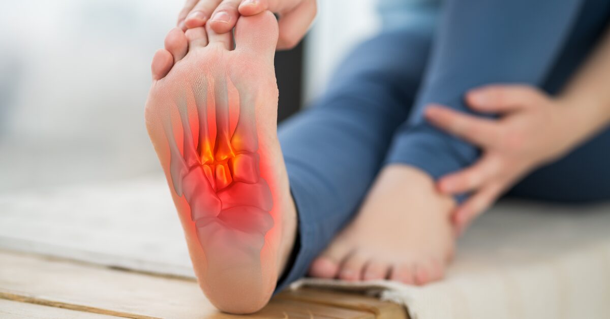 Lokalizacija bolečine pri plantarnem fasciitisu - območje plantarne fascije označeno rdeče