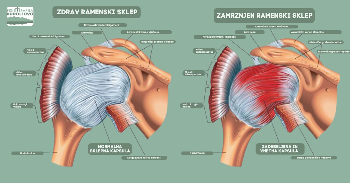 Primerjava zdravega in zamrznjenega ramenskega sklepa - anatomija adhezivnega kapsulitisa z označenimi mišicami rotatorne manšete in sklepno kapsulo