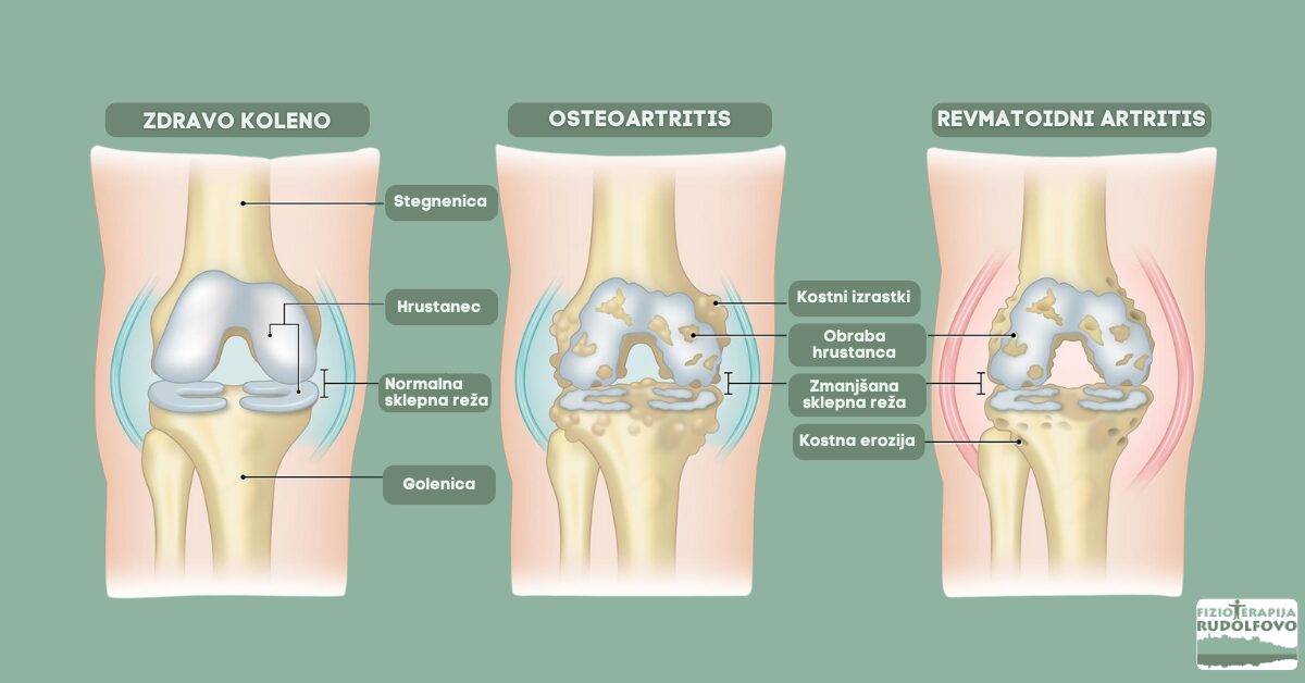 Primerjava zdravega kolena, osteoartritisa in revmatoidnega artritisa – anatomski prikaz