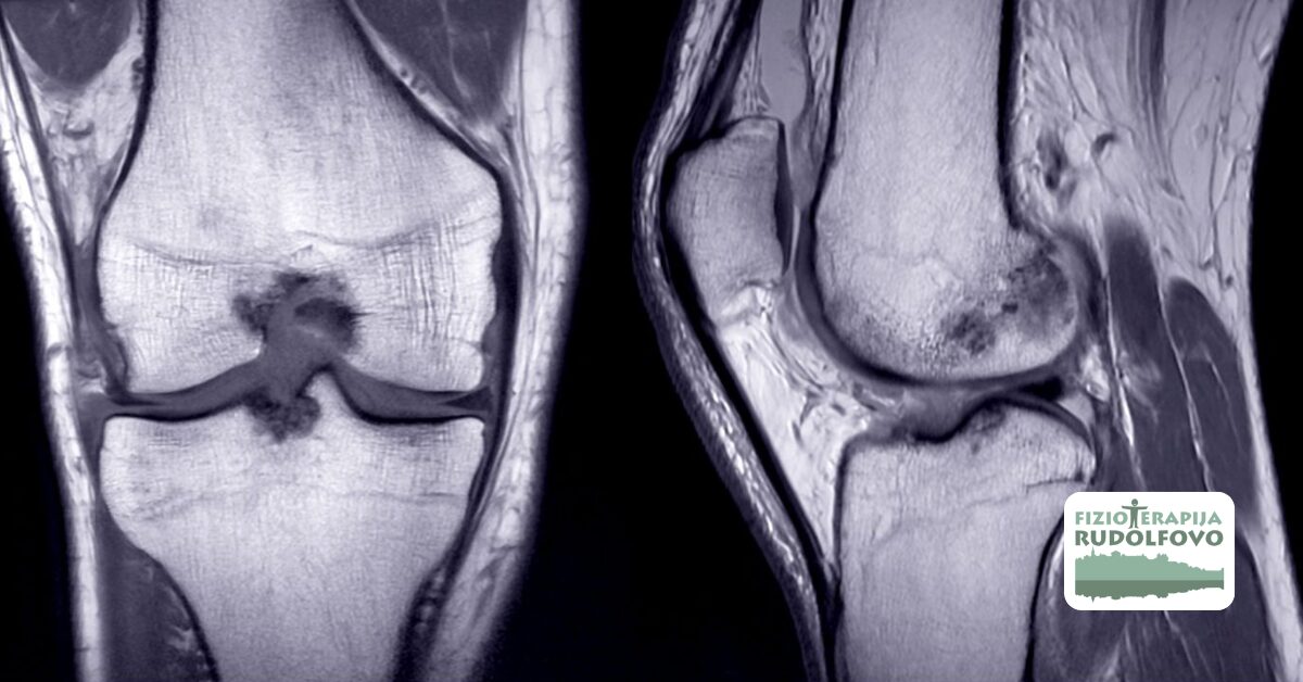 MRI posnetek kostnega edema v kolenu - temna območja prikazujejo kopičenje tekočine v kosti pri diagnostiki