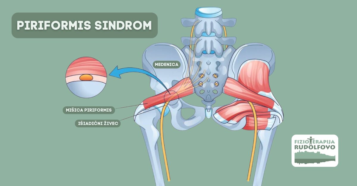 Anatomija piriformis sindroma - diagram mišice piriformis in ishiadičnega živca v medenici