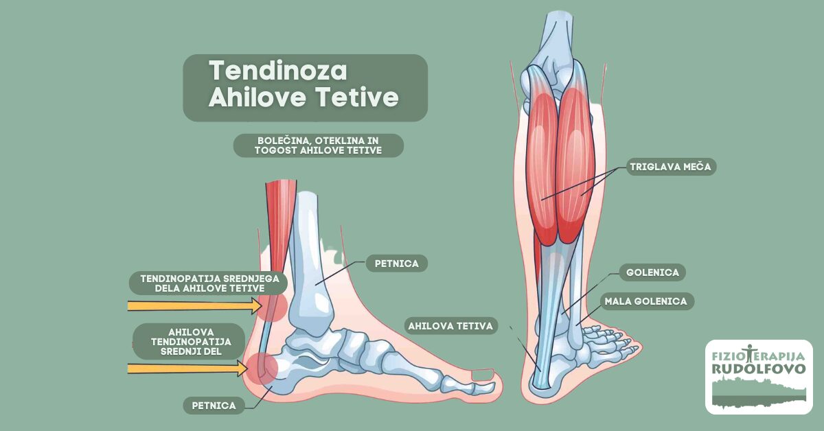 Anatomski prikaz tendinoze ahilove tetive - lokacija bolečine, otekline in togosti v srednji in spodnji del ahilove tetive ter mečni mišici
