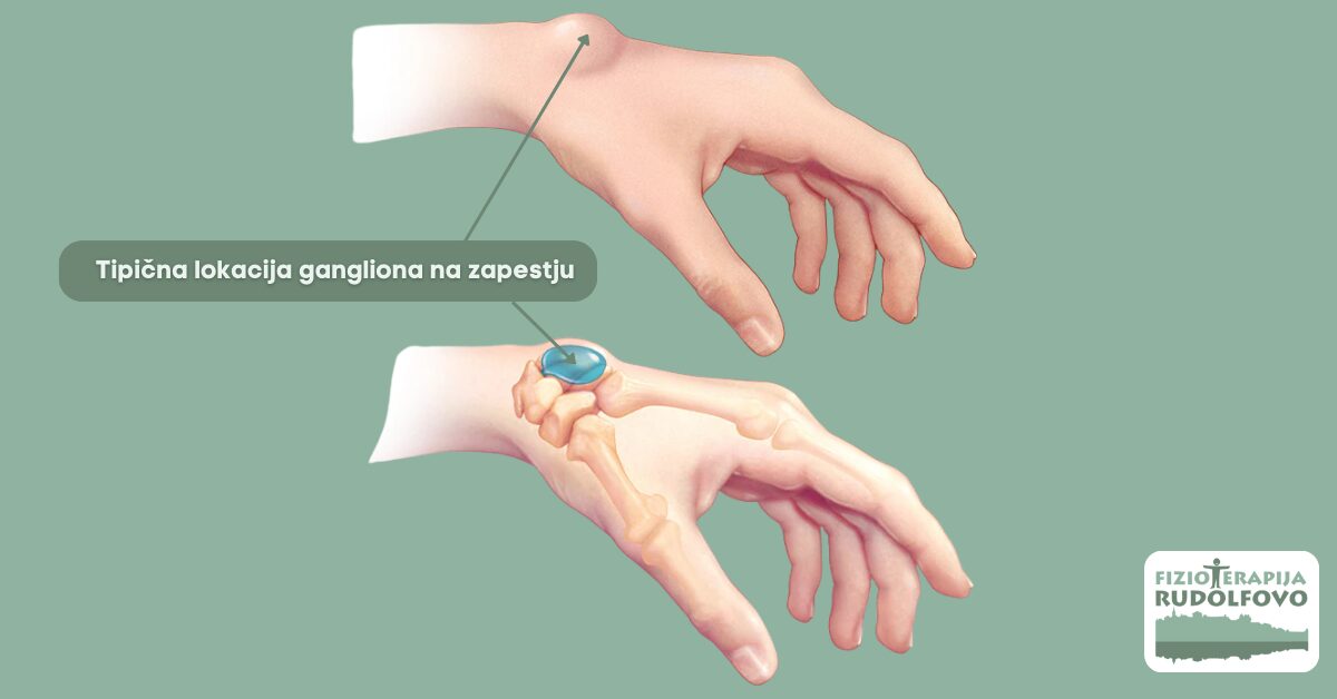 Anatomska ilustracija gangliona na zapestju prikazuje cistično tvorbo na hrbtni strani zapestja - dorzalni ganglion, najpogostejša lokacija pojavljanja