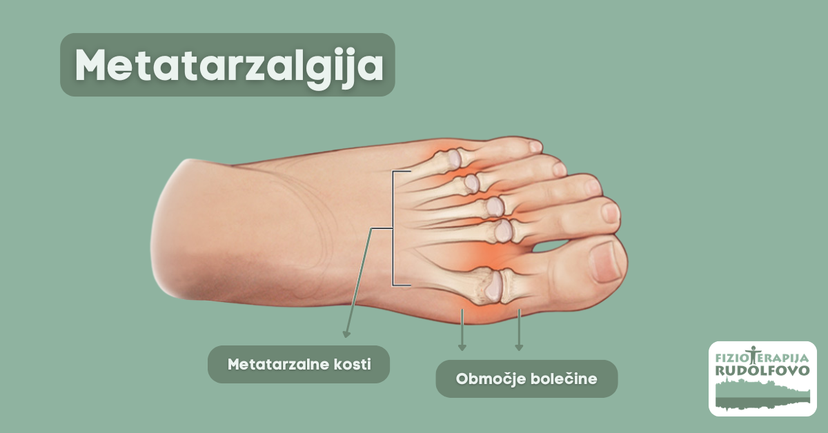 Anatomski prikaz metatarzalgije z označenimi metatarzalnimi kostmi in območjem bolečine v blazinicah stopala