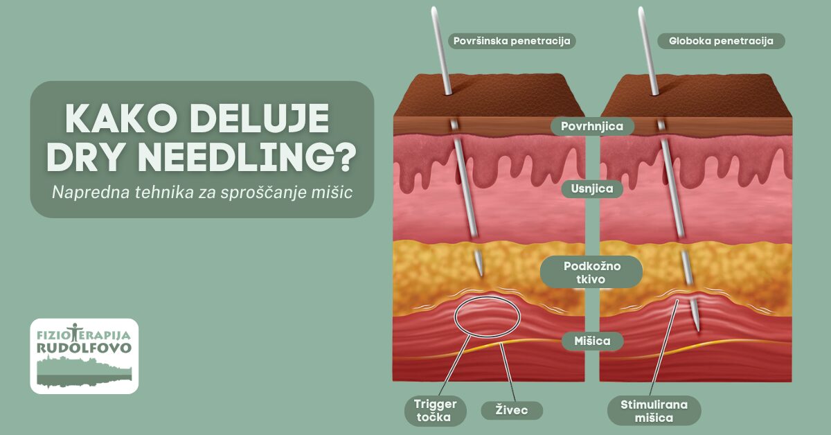 Kako deluje dry needling terapija - anatomski prikaz površinske in globoke penetracije trigger točk, povrhnjice, usnjice, podkožnega tkiva in mišice - Fizioterapija Rudolfovo Novo mesto