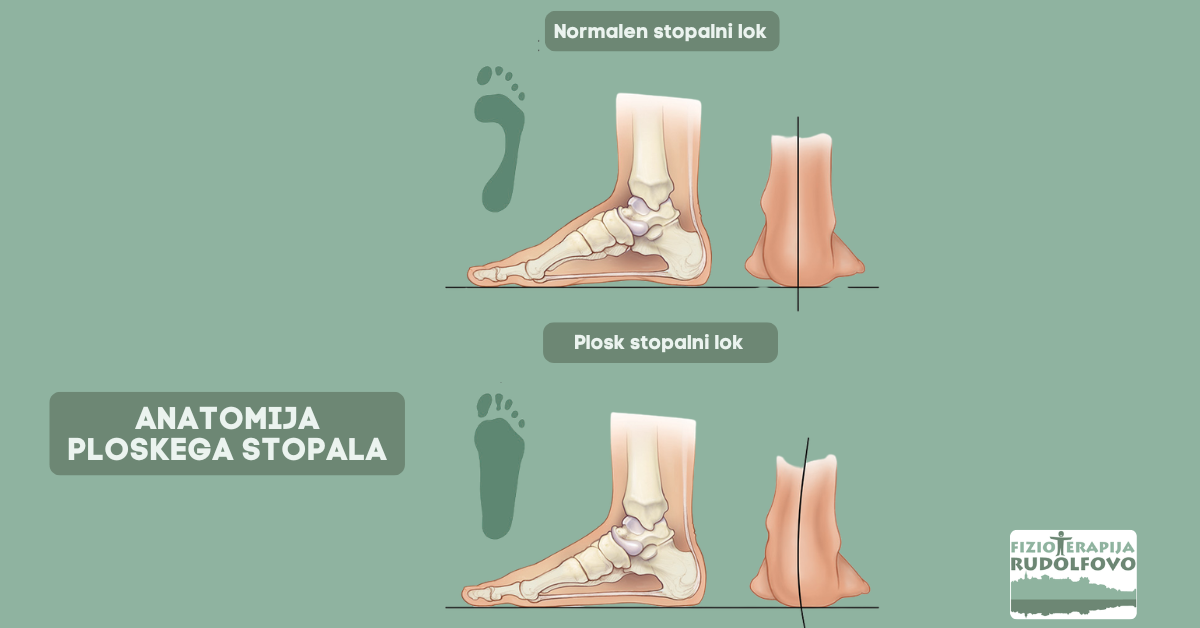 Anatomija ploskega stopala — primerjava normalnega in ploskega stopalnega loka