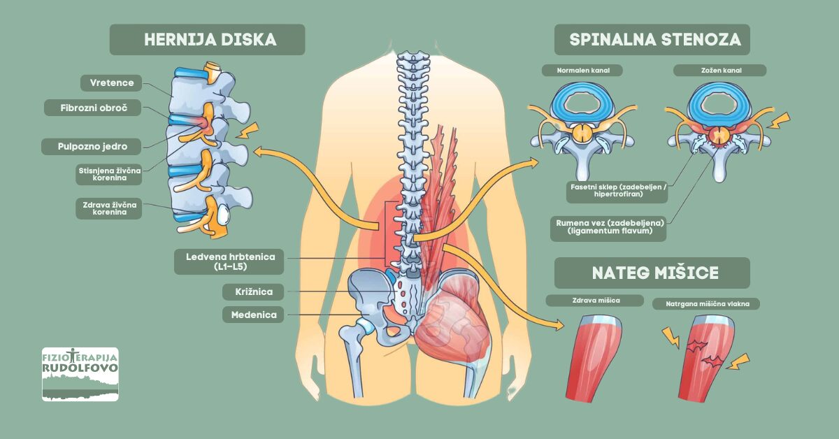 Bolečine v križu - vzroki: hernija diska, spinalna stenoza in nateg mišice